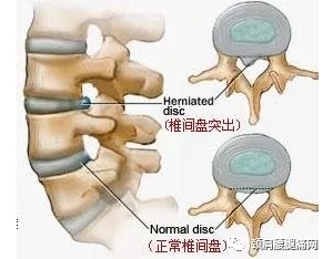 腰椎滑脱和腰椎间盘突出的区别介绍