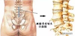颈肩腰腿痛网：骨质增生知识知多少