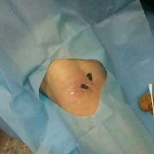 参加痛王弧刃小针刀培训后治疗膝关节滑膜炎临床病案