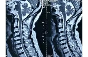 重症颈椎病疼痛麻木难忍，痛王弧刃针联合椎间盘射频及椎管内药物治疗 ...