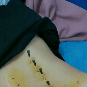 弧刃针治疗腰椎间盘突出椎管狭窄临床病例 | 腰疼培训