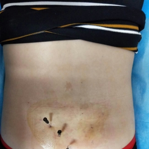 颈椎腰椎培训后轻松应对腰部疼痛活动受限临床患者