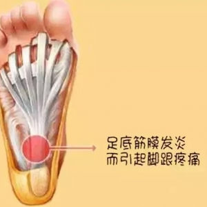 痛王医学院培训老师介绍：足跟痛可能是足底筋膜炎惹的祸