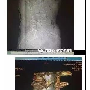 腰椎压缩性骨折疼痛，用弧刃针标准疗法治疗