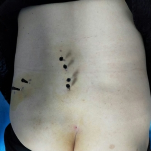 颈肩腰腿痛病例：左腰部伴臀部放射性疼痛的弧刃针治疗