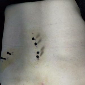左腰部伴臀部放射性疼痛，弧刃针刀治疗一次后明显改善