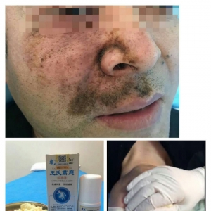 头面部严重带状疱疹患者，痛王药酒配合火灸治疗后疼痛减轻 ...