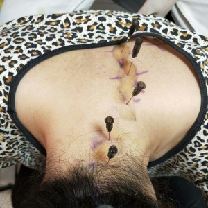多年颈椎病患者伴左肩胛区酸困不适，弧刃针治疗后症状减半 ...