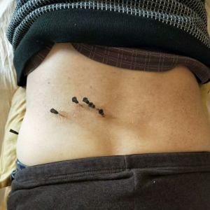 腰骶部疼痛2月按摩后症状缓解不明显，弧刃针松解后症状即减半 ...