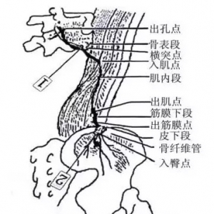 腰臀部疼痛针刀治疗方法 | 针刀培训