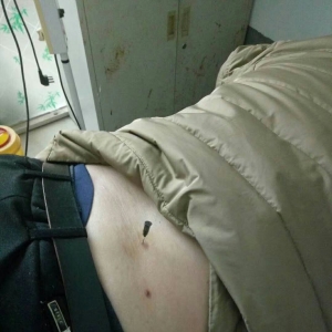 颈肩腰腿痛培训十合一精华班学员赵全伟大夫分享临床病例