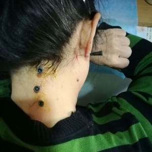 头疼头晕颈部酸胀、双手麻木怎么办？弧刃针有奇效！