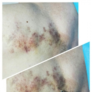 带状疱疹疼痛难忍严重影响睡眠，弧刃针皮下扫散及臭氧治疗 ...