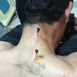 弧刃针标准疗法治疗严重颈椎病伴手指麻木头痛患者