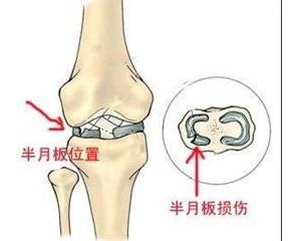膝关节疼痛之半月板损伤的分度与临床表现