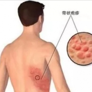 患了带状疱疹后神经痛并不可怕，正确的治疗最关键!