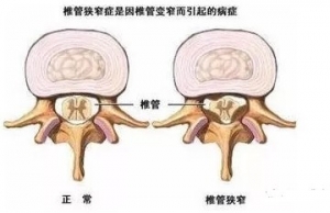 尸体解剖——腰椎管