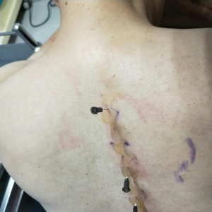 弧刃针治疗后配合关节错缝术轻松应对胸椎小关节错缝