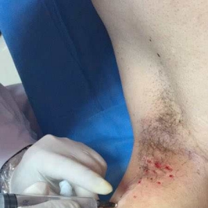 腋窝带状疱疹后遗神经痛数月，药物及理疗仍不减轻怎么办？ ...