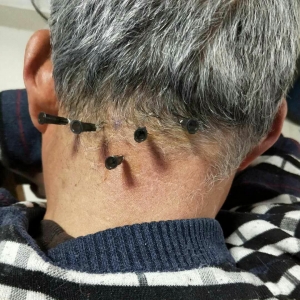 头痛头昏数年有时耳鸣，长期治疗效果不佳，弧刃针治疗后明显减轻 ...