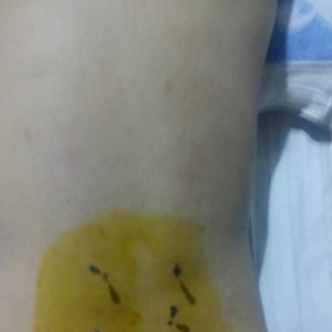 精华班培训学员分享双臀部酸痛严重的治疗病例