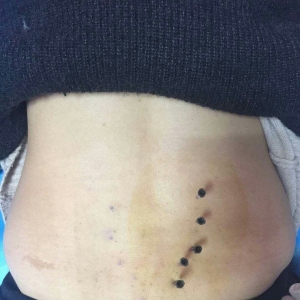 弯腰提重物时腰部疼痛怎么办？弧刃针立竿见影
