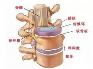 椎间盘突出与腰椎间盘突出症的区别