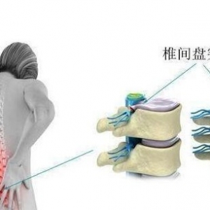 对于腰椎间盘突出的患者为什么有的建议手术，有的说不需要治疗？ ...