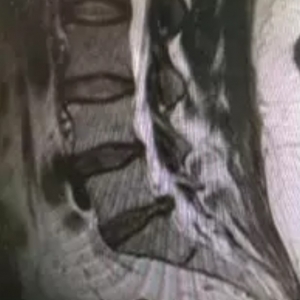 病例：弧刃针对腰椎间盘突出症的特殊治疗