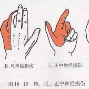 臂丛神经损伤的康复要点