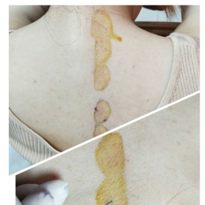 线针刀埋线治疗背部疼痛及调理高血压