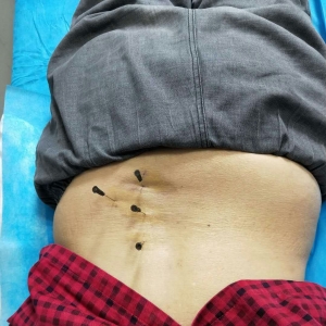 老年女性患者腰部疼痛伴右下肢酸困有什么好的治疗方法？