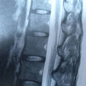 颈肩腰腿痛网：椎间盘源性腰痛科普及健康指导