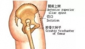 尸体解剖：髂前上棘