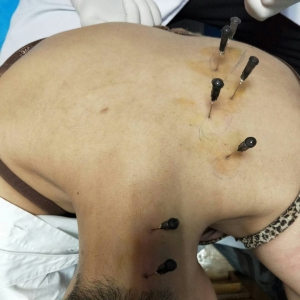 痛王弧刃针治疗颈部疼痛肩部酸困颈椎病患者