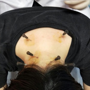 颈椎病伴头痛头晕，痛王弧刃小针刀治疗