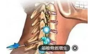 颈椎病导致手麻、疼痛、肌无力是怎么回事？