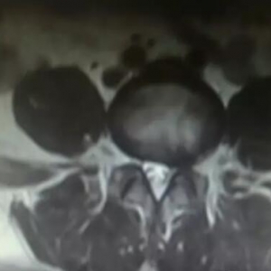 弧刃针刀治疗腰椎间盘突出症的病例分享