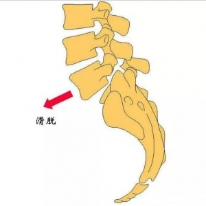 腰椎滑脱是什么情况？