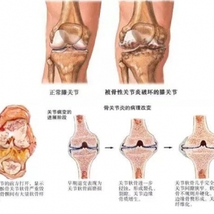 非化脓性关节炎引起的膝盖疼痛有哪些？