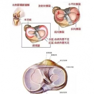 软组织损伤引起的膝关节疼痛有哪些？