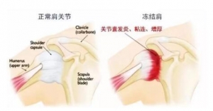 肩周炎包括十几种肩周疾病，临床常见的主要有2种