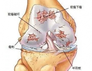 骨关节炎患者几种简单易学的健身方法介绍