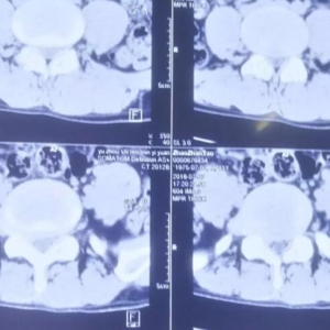 极外侧腰椎间盘突出症的弧刃针治疗