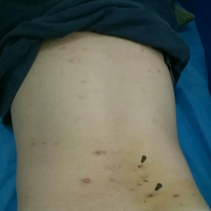 精华班培训学员病例：弧刃针治疗腰椎间盘突出、坐骨神经痛患者 ...