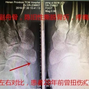 不是副舟骨，陈旧性撕脱骨折，疼痛20年，注意左右对比。