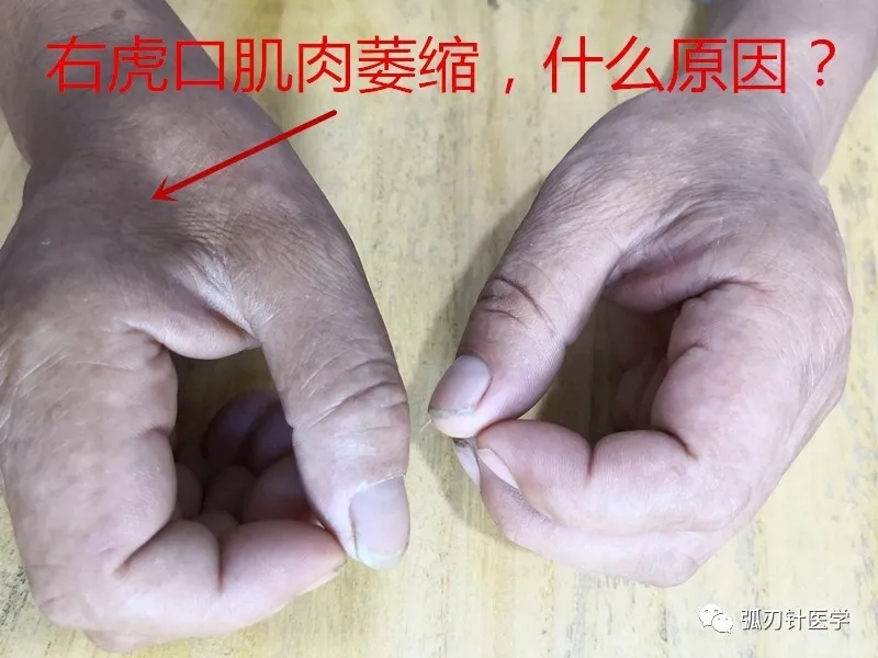 右虎口肌肉萎缩,什么原因?