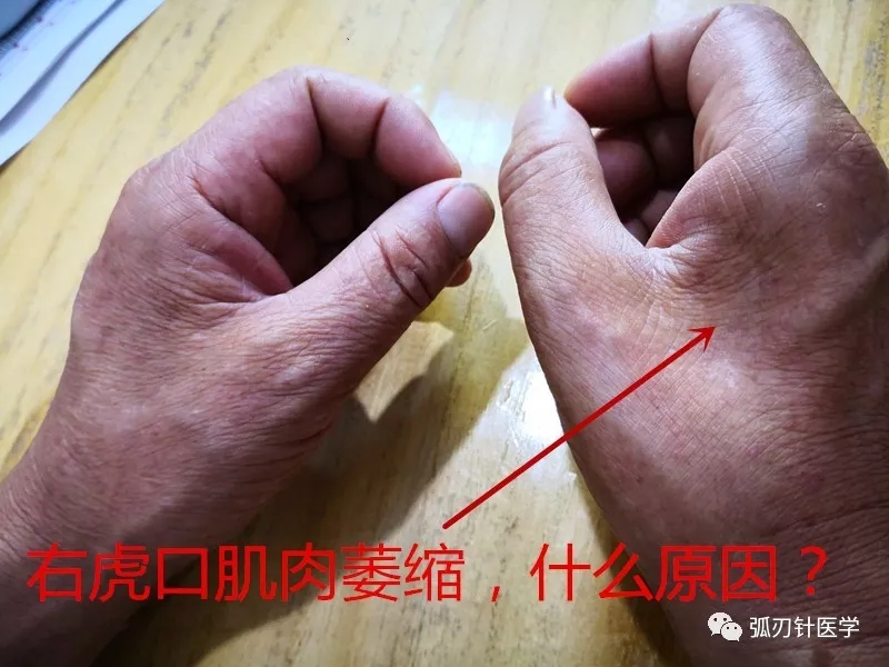 右虎口肌肉萎缩,什么原因?