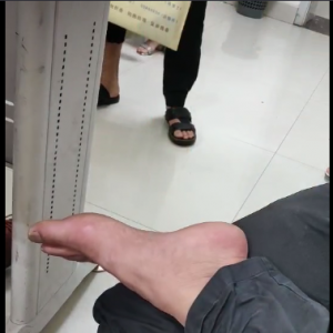 典型|38岁男，早起大足趾莫名红肿热痛，不能行走