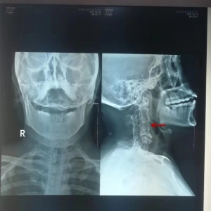 很经典，两例颈椎典型阻滞椎